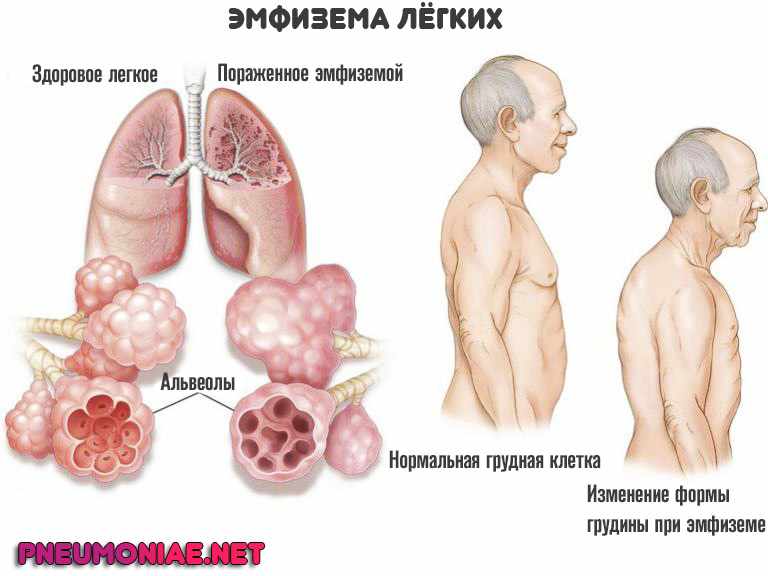эмфизема