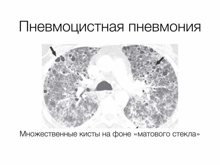porazheniya-pri-pnevmocitoze