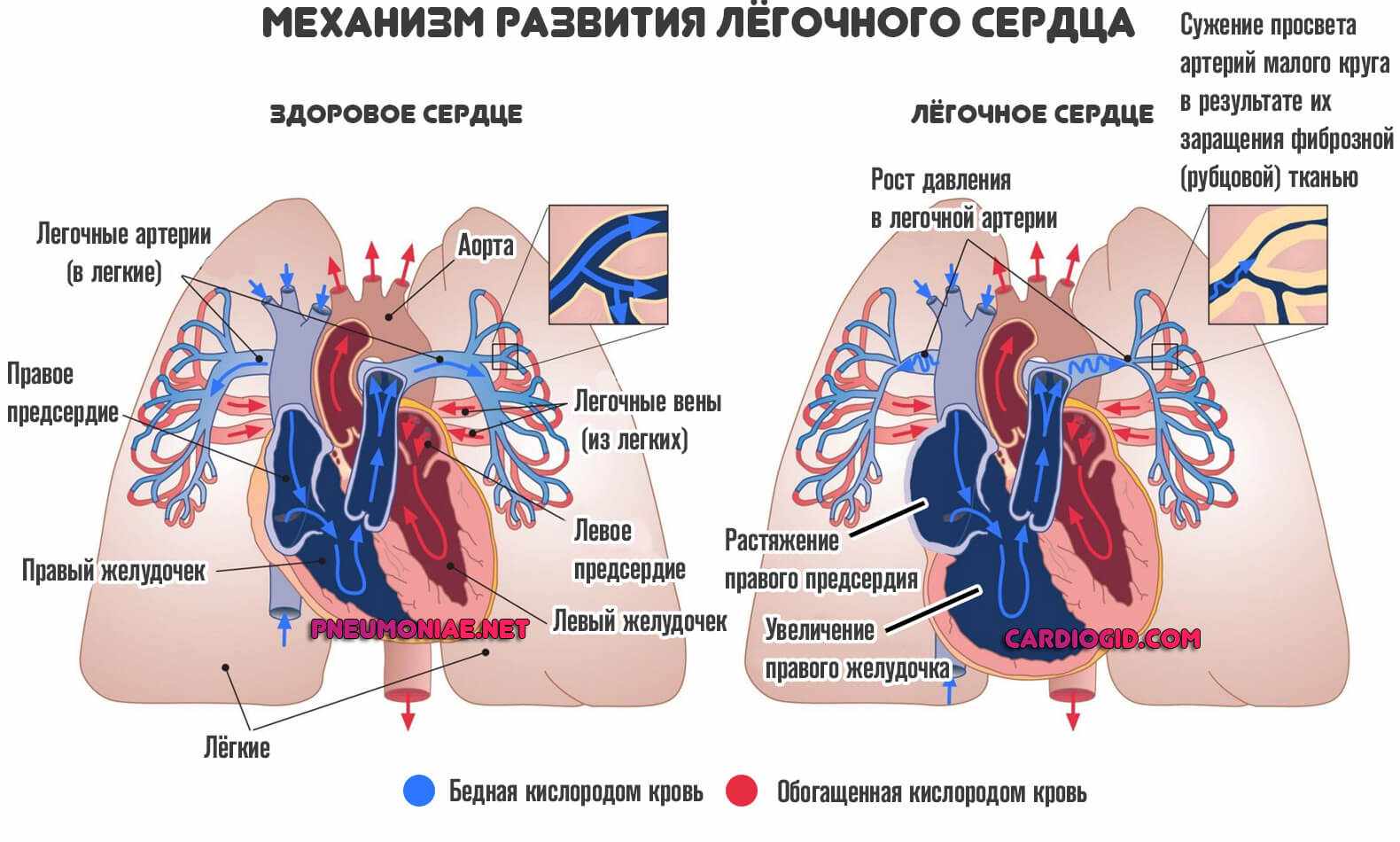 легочное-сердце