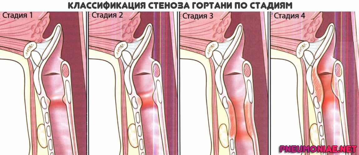 классификация-стеноза-гортани
