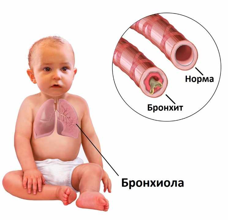 бронхит у ребенка