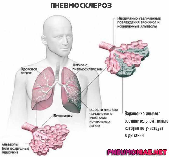 пневмосклероз