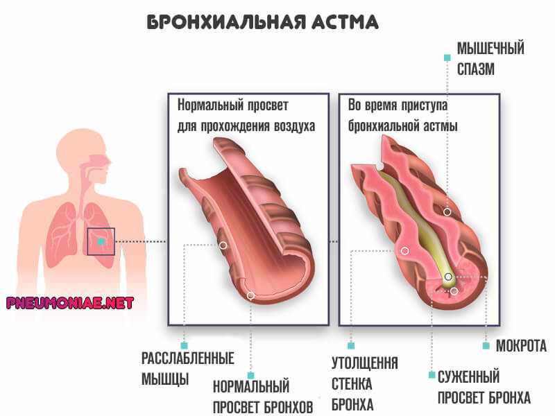 бронхиальная-астма