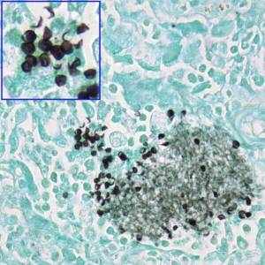 Pneumocystisjiroveci