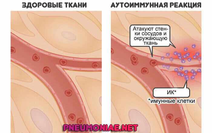 аутоиммунная-реакция