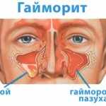 Гайморит у ребенка: симптомы и лечение