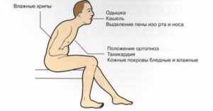 Вода в легких - симптомы и лечение