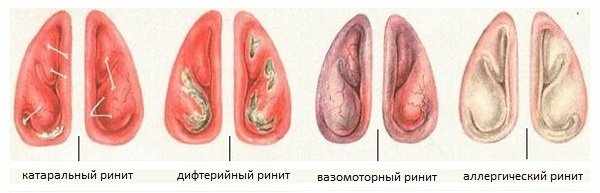 Лечение насморка в домашних условиях народными средствами