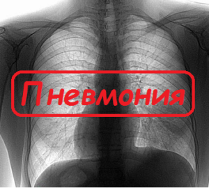 Пневмония что это такое и как ее лечить?