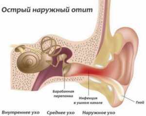 Как удалить ушную пробку перекисью водорода за 20 минут?