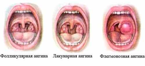 Ангина у ребенка в 2 года: симптомы и лечение