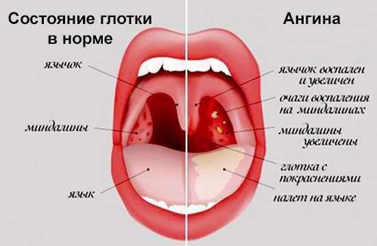 болит горло