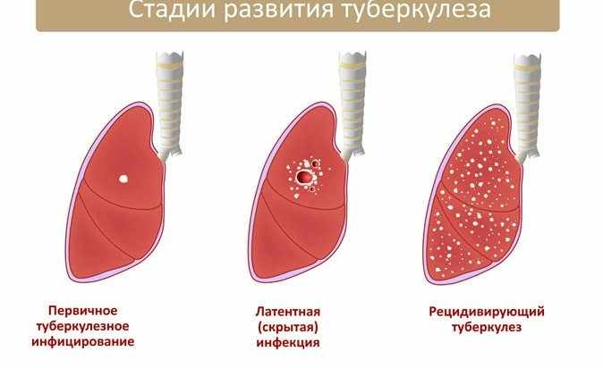осумкованный плеврит