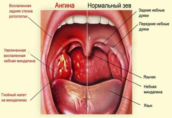 Как и чем вылечить быстро ангину у взрослого в домашних условиях?