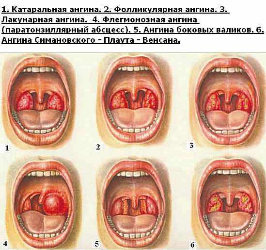 Как лечить ангину у детей?