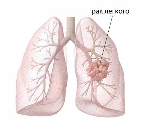 Плевральный выпот: что это такое?