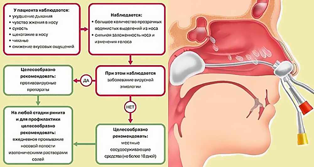 Что такое ринит и чем его лечить?