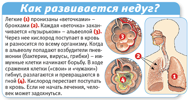 Что такое крупозная пневмония - симптомы и лечение