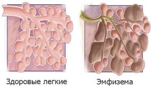 Сколько живут с эмфиземой легких?