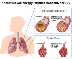 Что такое обструктивный бронхит и как его лечить у взрослых?