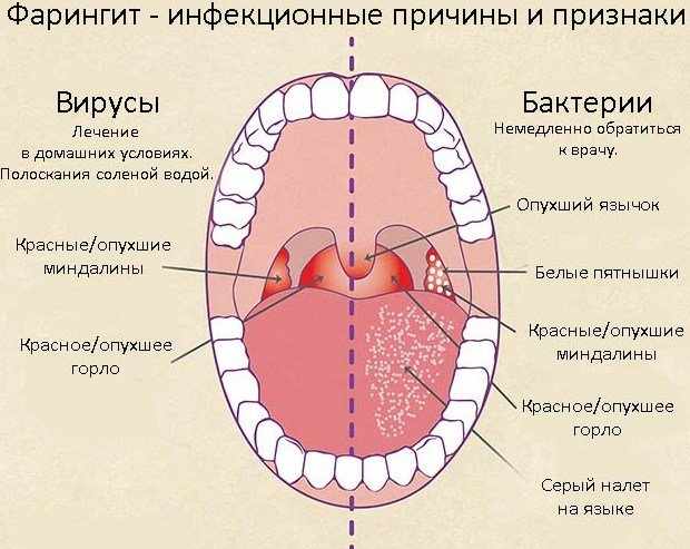 воспаленное горло