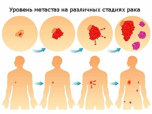 центральный рак легких