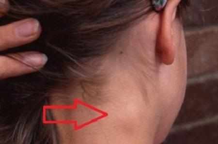 От чего увеличиваются лимфоузлы?