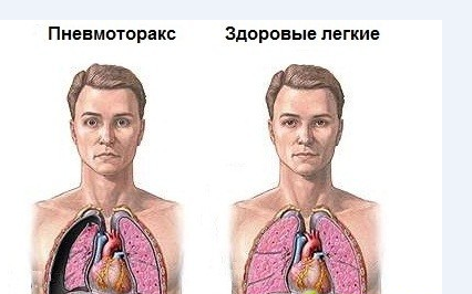 Заболевания органов дыхания и их симптомы