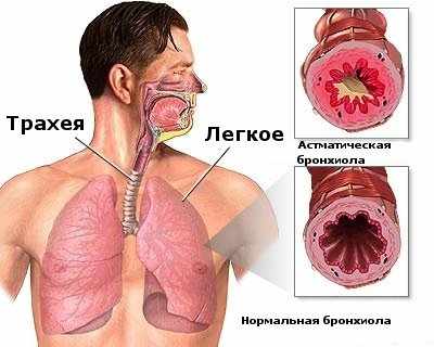 бронхиальная астма симптомы
