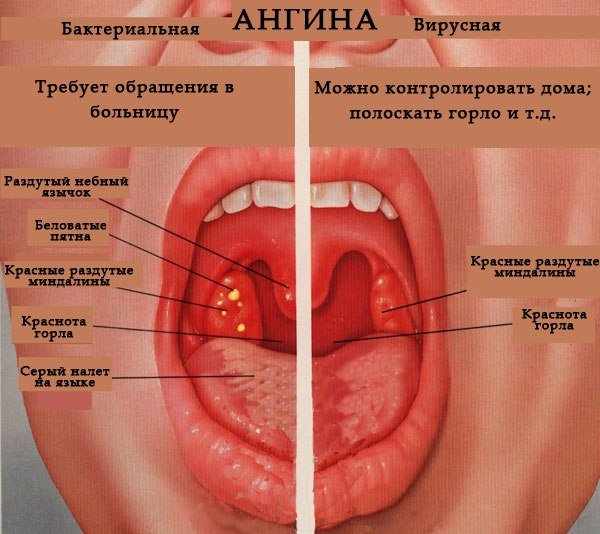 ангина