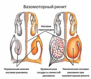 Чем лечить насморк при беременности?