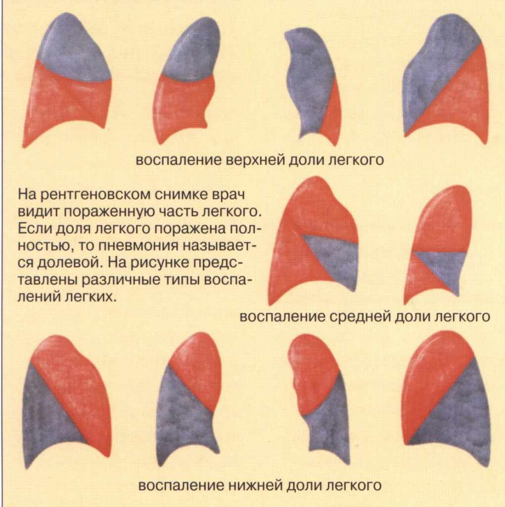 Двухсторонняя пневмония: что это такое?