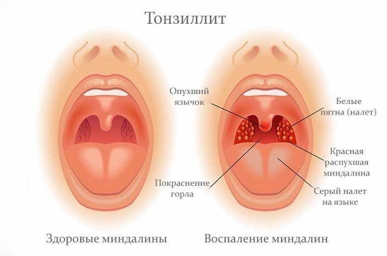 Что делать если у взрослого в горле скапливается слизь как сопли?