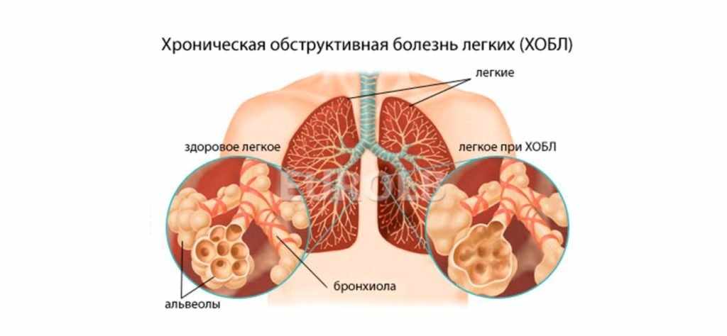 Что такое хронический бронхит и как его вылечить навсегда?