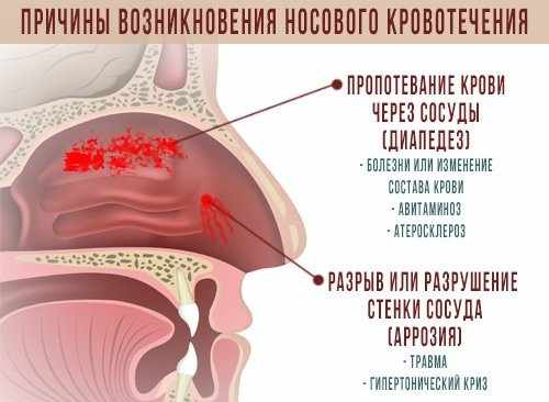 Почему идет кровь из носа у взрослого - причины