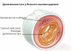 Симптомы и лечение муковисцидоза у взрослых