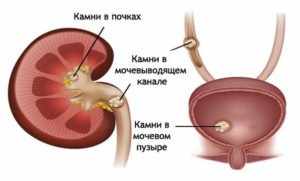 Искусственная вентиляция лёгких: техника проведения и осложнения