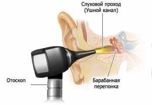 Как самостоятельно удалить ушную пробку?