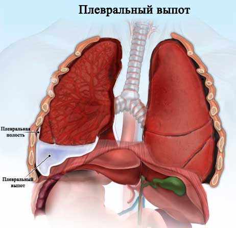 Что такое плевральная полость?