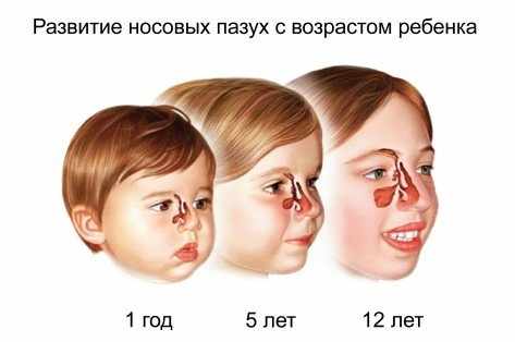 Гайморит у ребенка: симптомы и лечение