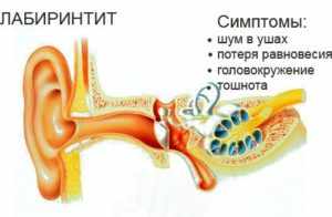 Какие антибиотики принимать при отите у взрослых?