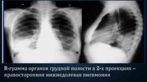 Правосторонняя нижнедолевая пневмония у взрослых и детей