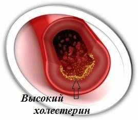Причины, симптомы и стадии гипертонии