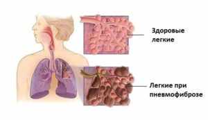 Пневмофиброз легких - что это такое и чем опасен?