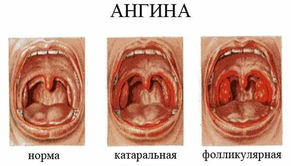 готовый раствор фурацилина