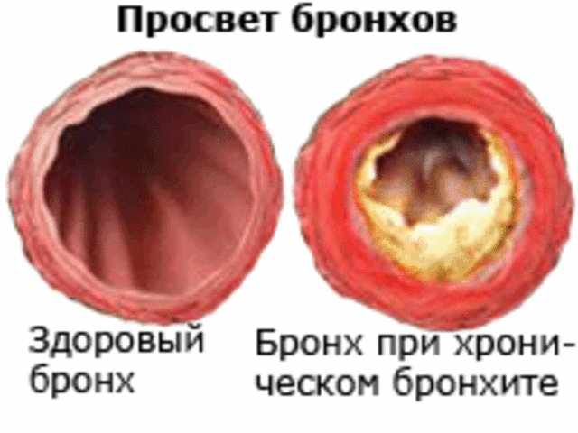 Как очистить бронхи от мокроты?