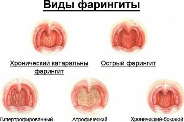 виды фарингита