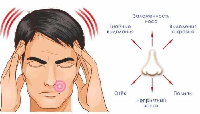 Пансинусит что это такое и как его лечить?