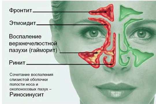 бактериальный насморк