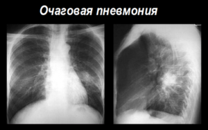 Двухсторонняя пневмония: что это такое?